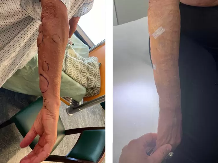  Sindrome lipoma multiplo pre e post